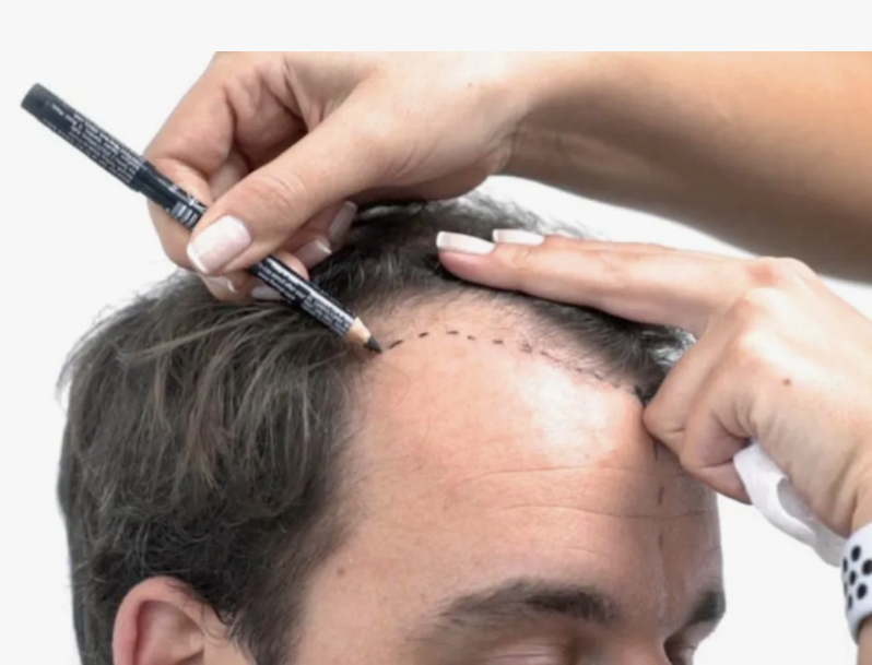 Bahçeşehir Saç Ekimi